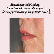 Perioral lines treated at MedAndSpa