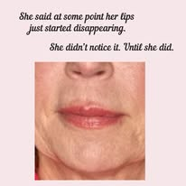 Lip filler result restoring natural lip volume