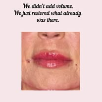 Real client lip restoration result at MedAndSpa Burr Ridge