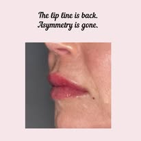 Lip line and symmetry restored after treatment