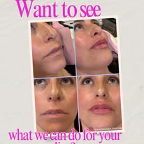 Real client facial rejuvenation results at MedAndSpa Burr Ridge